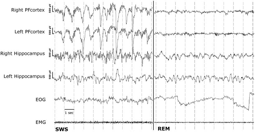 EEG: Early Indicator Of Autism